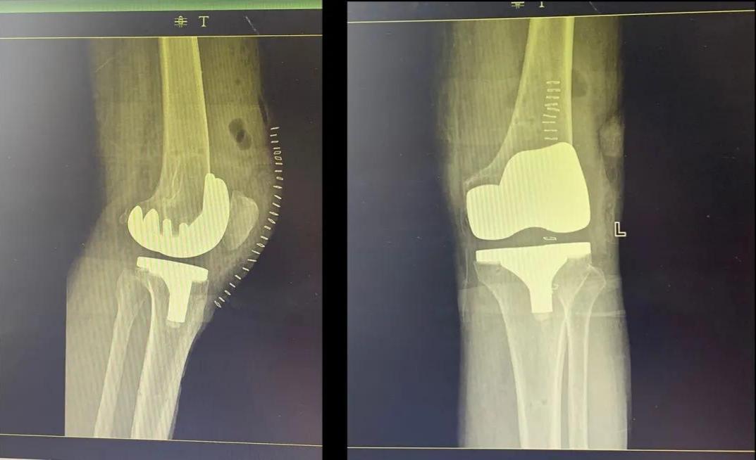 【6周年】专题Ⅲ之走进骨科——守护百姓骨骼健康(图9)