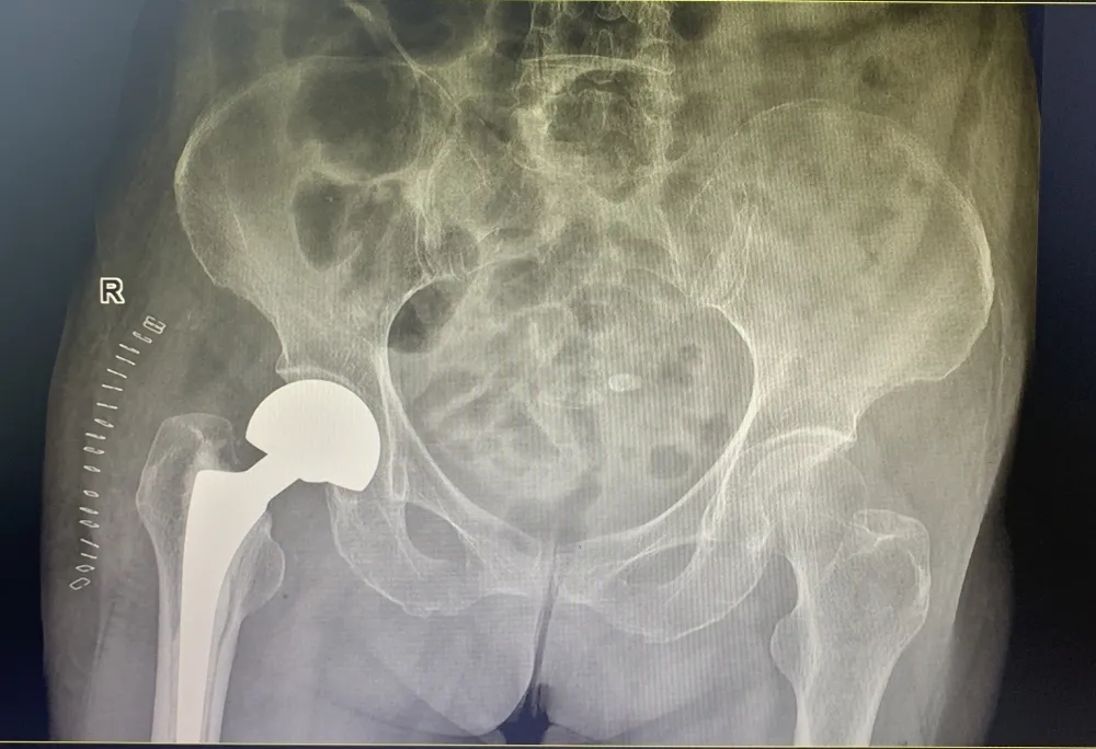 【6周年】专题Ⅲ之走进骨科——守护百姓骨骼健康(图10)